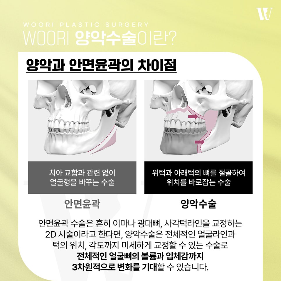 얼굴비대칭 양악수술로 개선 가능한 경우는? 관련 이미지 2