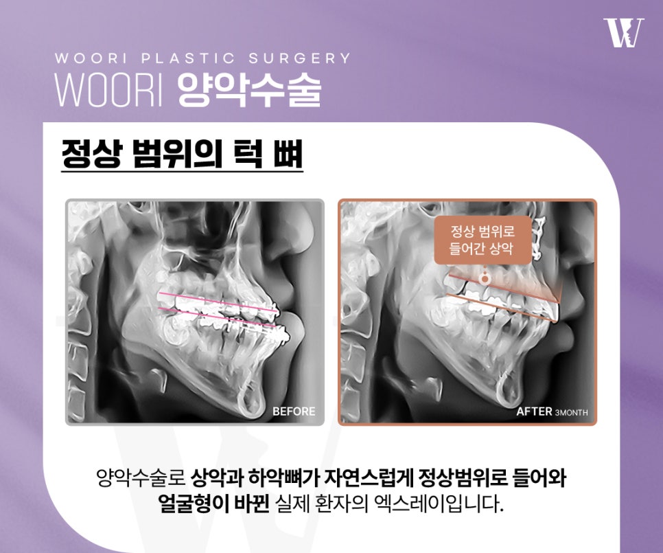 양악수술후기 외모보다 기능 변화가 만족스러운 이유 관련 이미지 6