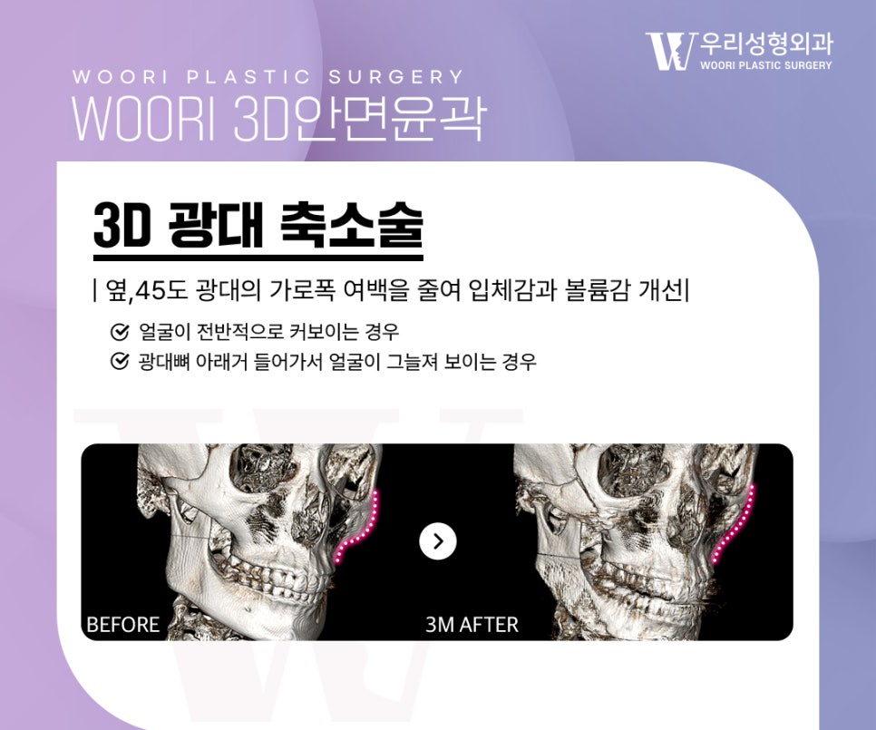 윤곽수술로 얼굴이 작아 보이는 이유는 무엇일까 관련 이미지 2