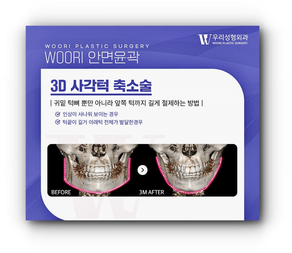 안면윤곽 3종 얼굴형에 큰 변화를 관련 이미지 3