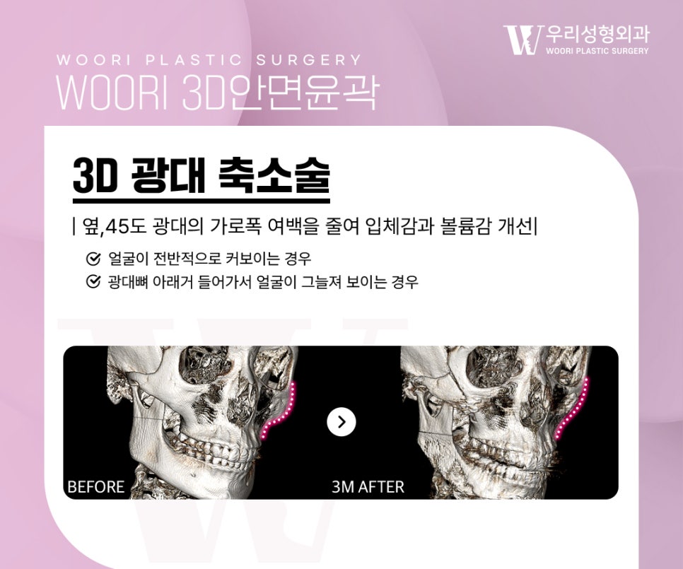 옆광대축소 후 얼굴이 더 작아 보이는 진짜 이유 관련 이미지 2