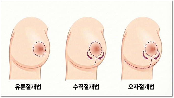 처진가슴 수술 포인트 알아보자 관련 이미지 3