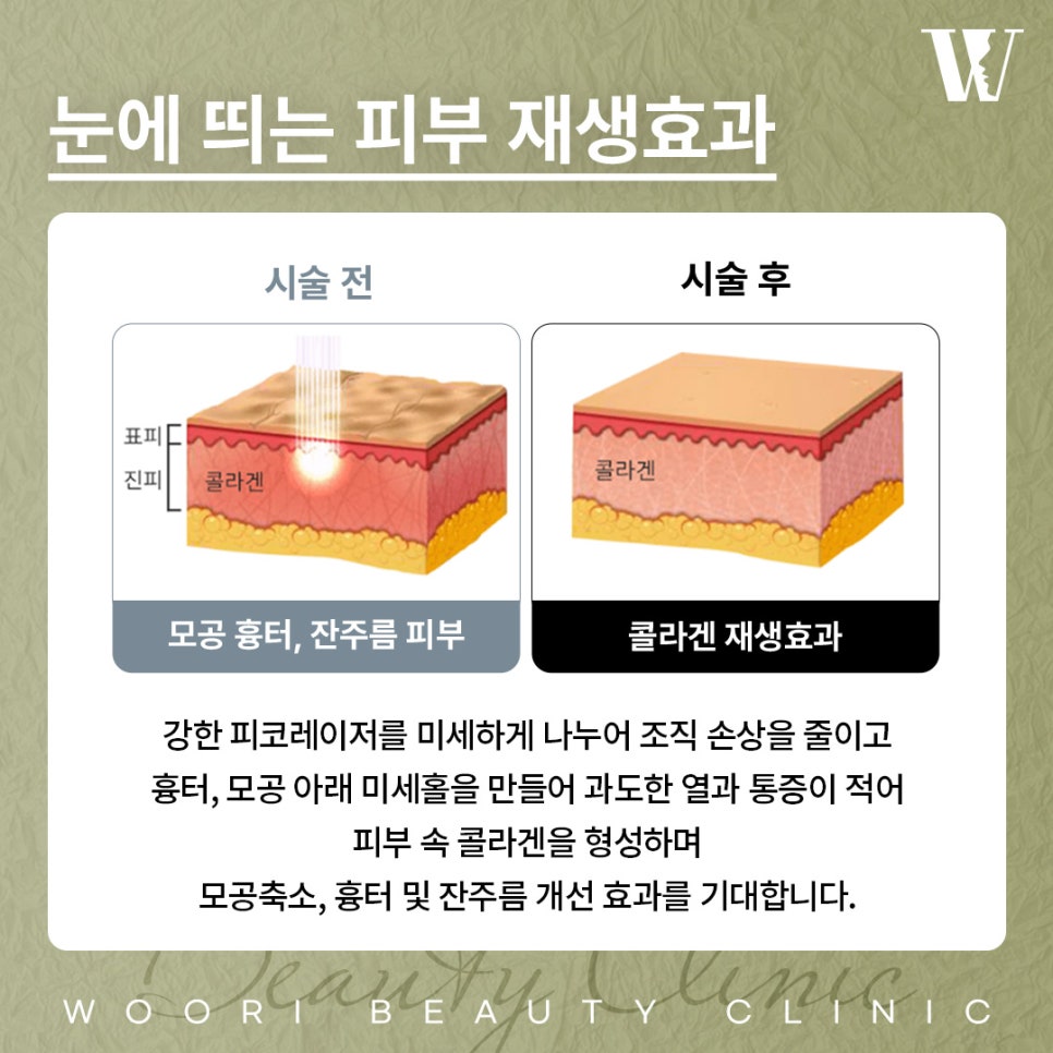 기미제거레이저 한 번에 없어지지 않는 이유는? 관련 이미지 4