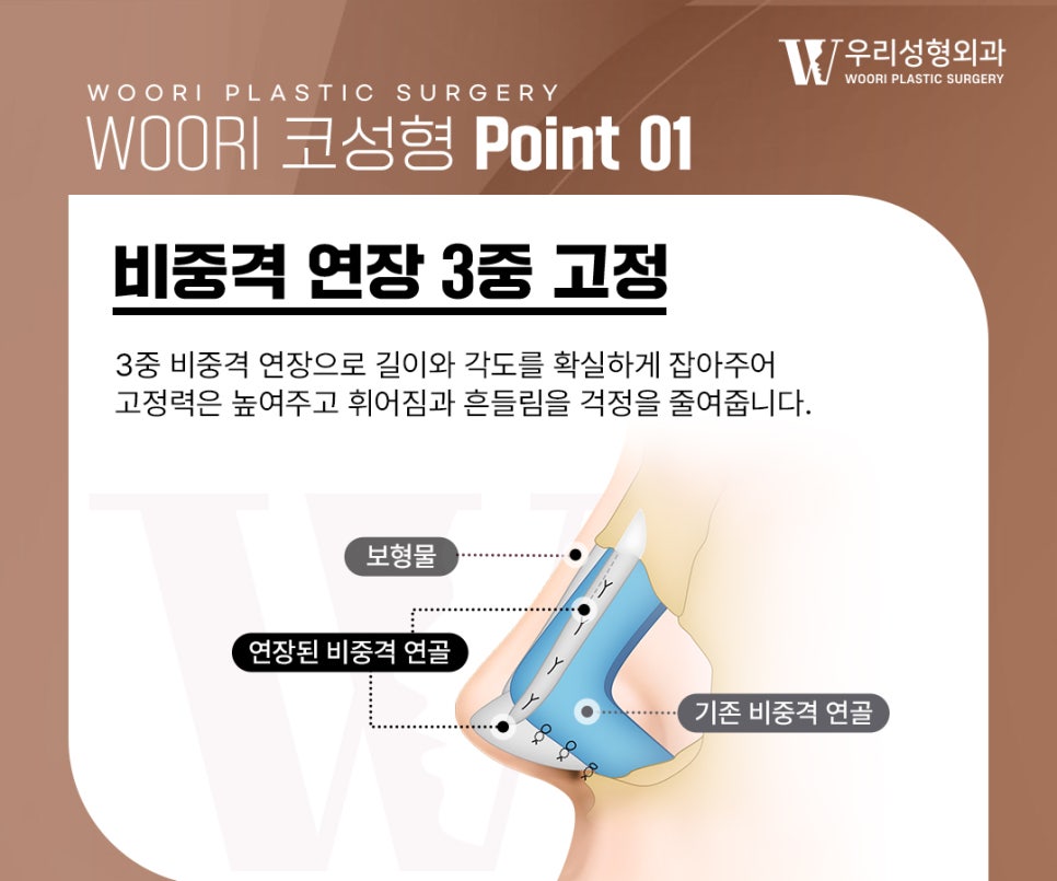 남자코수술에서 중요한 코끝 지지력 관련 이미지 2