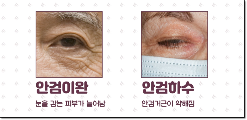 상안검수술 어떻게 진행되나요? 관련 이미지 3