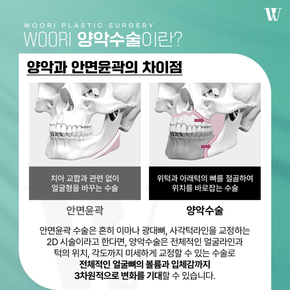 When Is It Difficult to Correct Facial Asymmetry with Contouring Surgery Alone? image 2