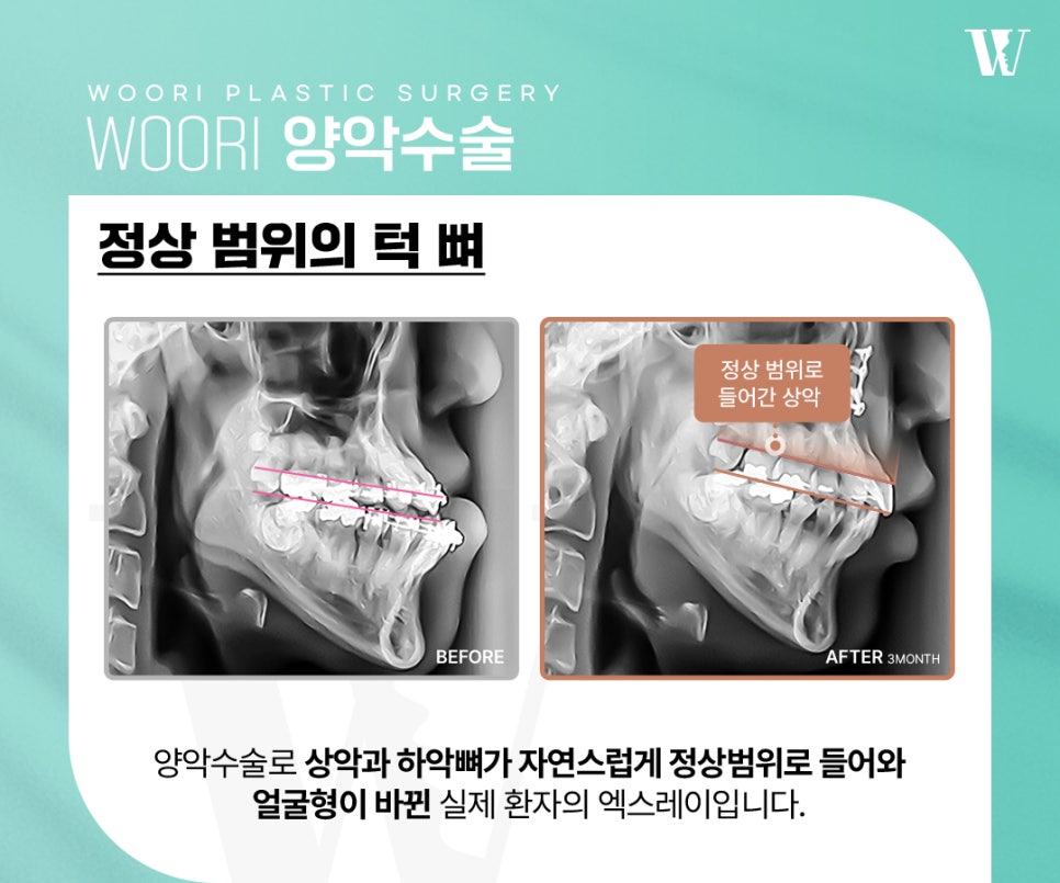 양악수술 안면윤곽과 무엇이 다를까? 관련 이미지 3