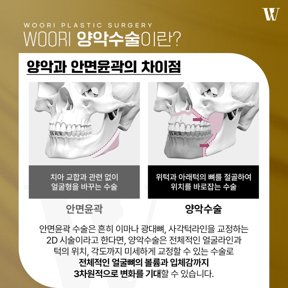 양악수술비용 어떤 부분에서 차이가 생길까? 관련 이미지 2