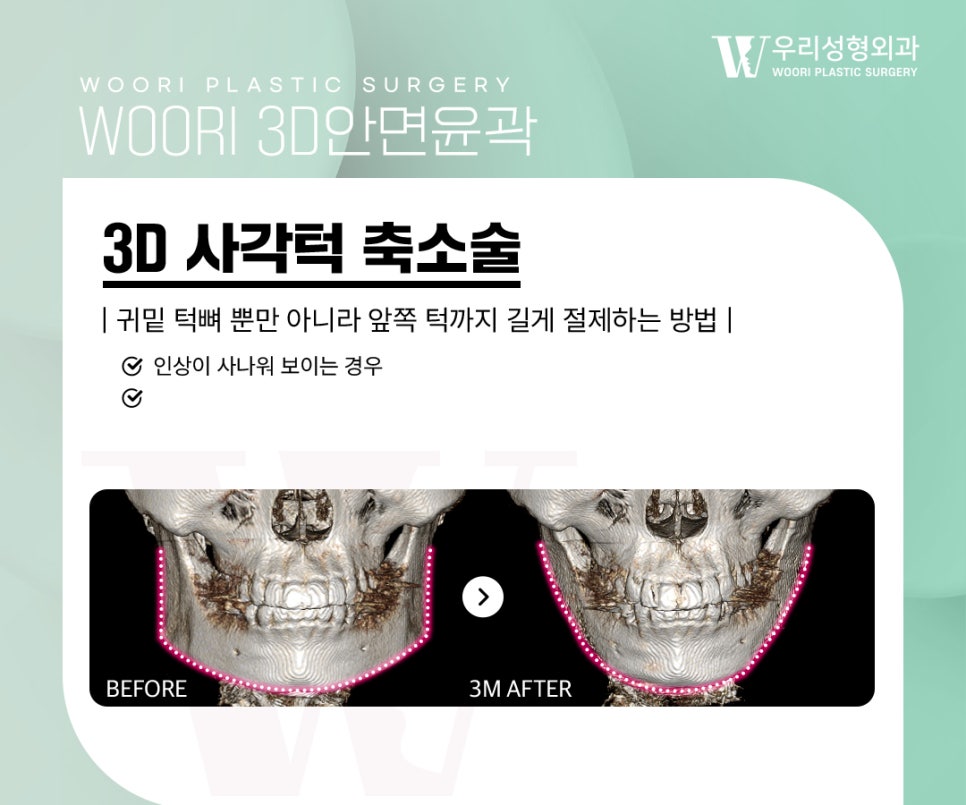 옆광대축소 단독으로 해도 변화가 클까? 관련 이미지 3