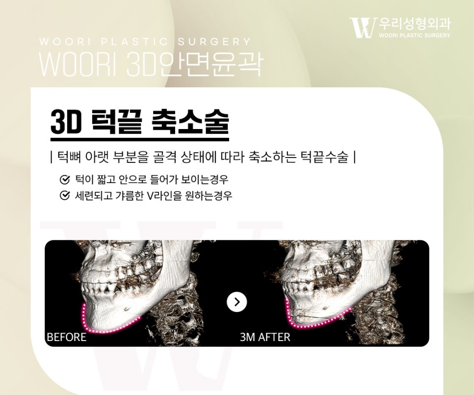 윤곽수술 얼굴형의 균형을 고려한 안면윤곽 방법 관련 이미지 4