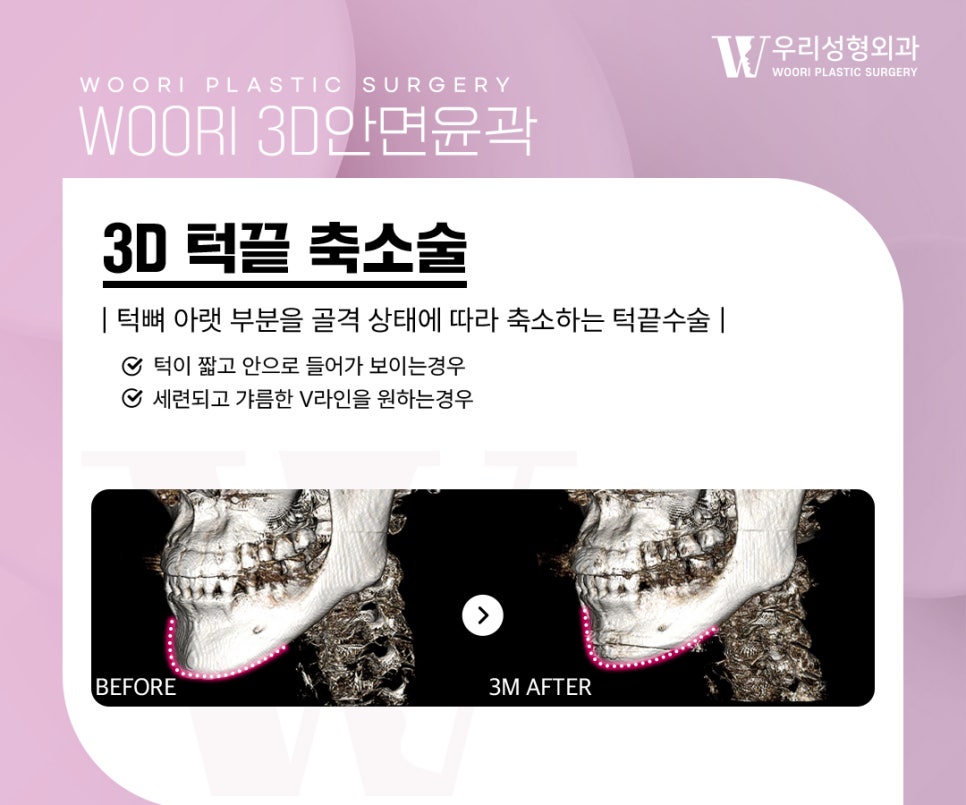 옆광대축소 후 얼굴이 더 작아 보이는 진짜 이유 관련 이미지 4