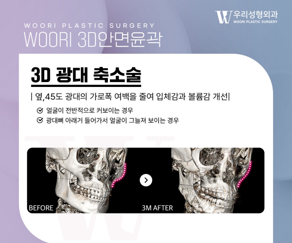광대축소술 후 처짐이 걱정된다면 고정 방법을 확인해야 하는 이유 관련 이미지 2
