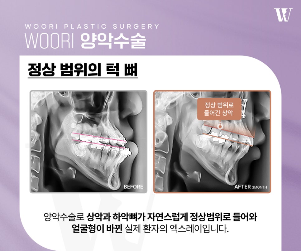 양악수술후기 주걱턱 돌출입 비대칭 케이스별 변화! 관련 이미지 5