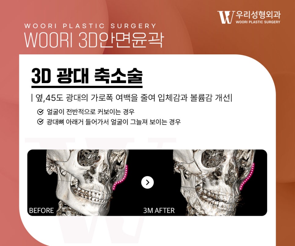 안면윤곽수술 얼굴 윤곽이 울퉁불퉁해 보이는 이유는? 관련 이미지 2