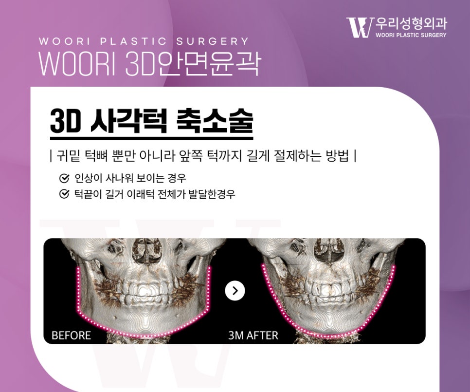 사각턱수술 함께 고려되는 윤곽 라인 개선 관련 이미지 2