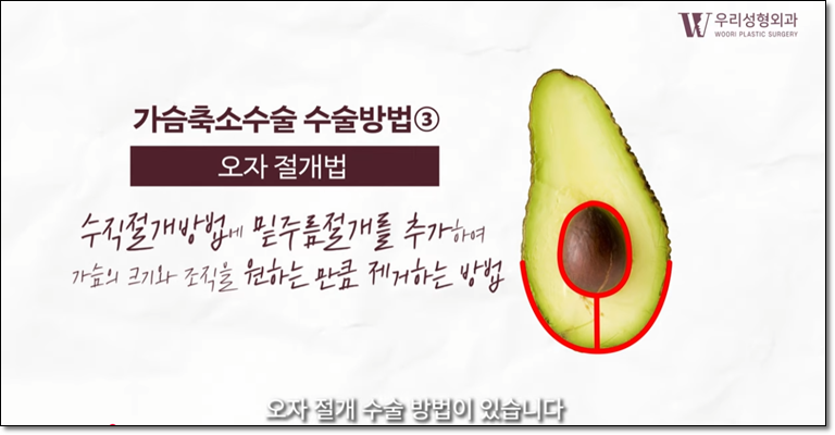 가슴축소 흉터 치료법 알아보자 관련 이미지 2