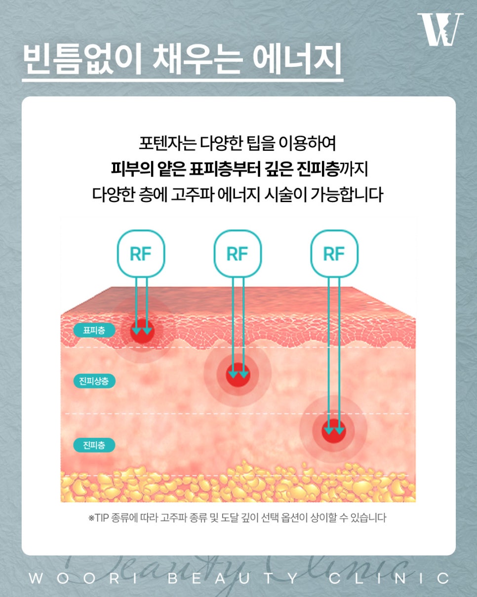 Why Is Potenza, a Pore Laser Treatment, Particularly Effective for Enlarged Pores? image 4