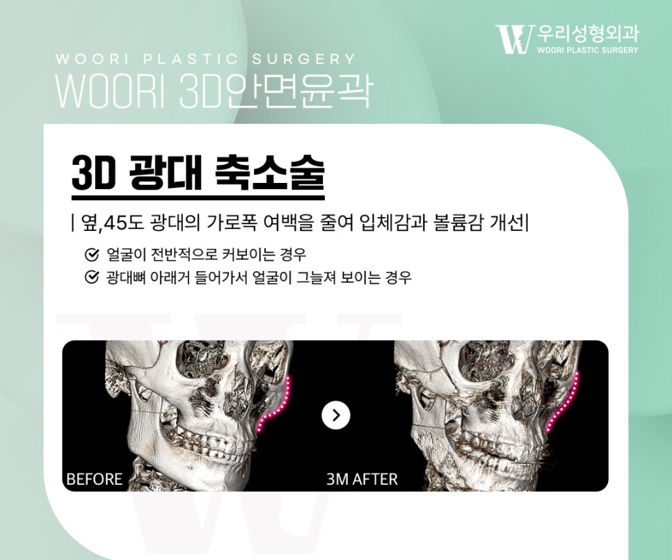 옆광대축소 단독으로 해도 변화가 클까? 관련 이미지 2