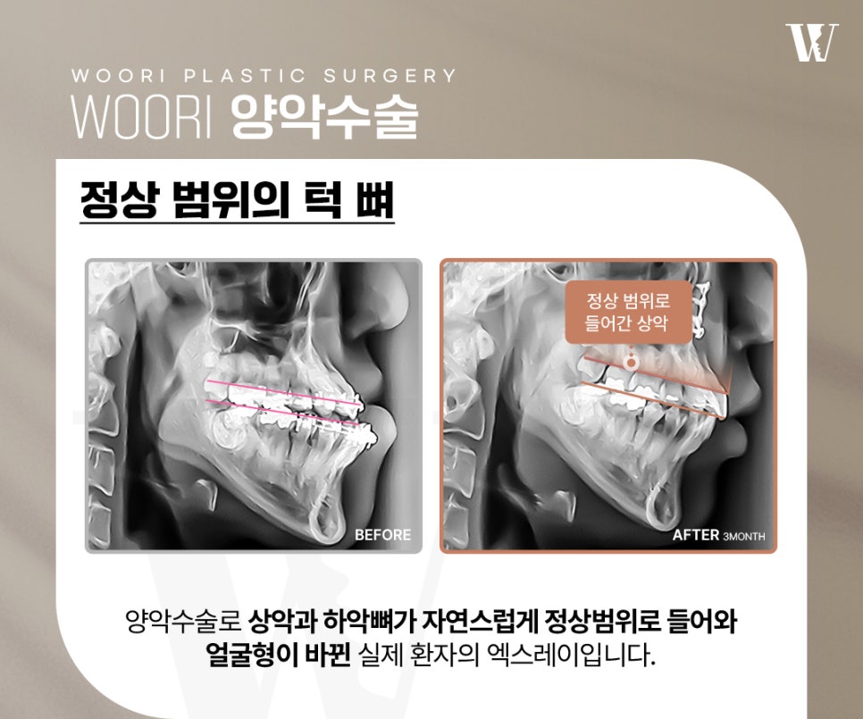 양악수술 얼굴 균형과 기능을 함께 고려하는 이유 관련 이미지 4