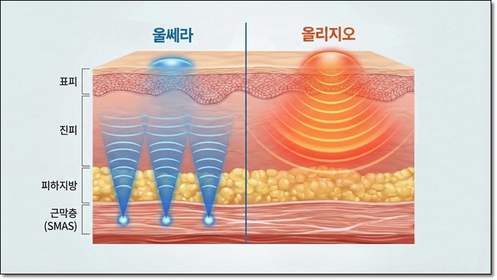 울쎄라효과 꿀조합 추천해요 관련 이미지 3