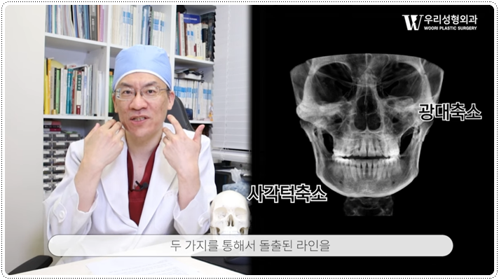 안면윤곽수술방법 땅콩형 얼굴은? 관련 이미지 3
