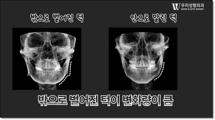 사각턱축소술 수술 방법 알아보자 관련 이미지 3