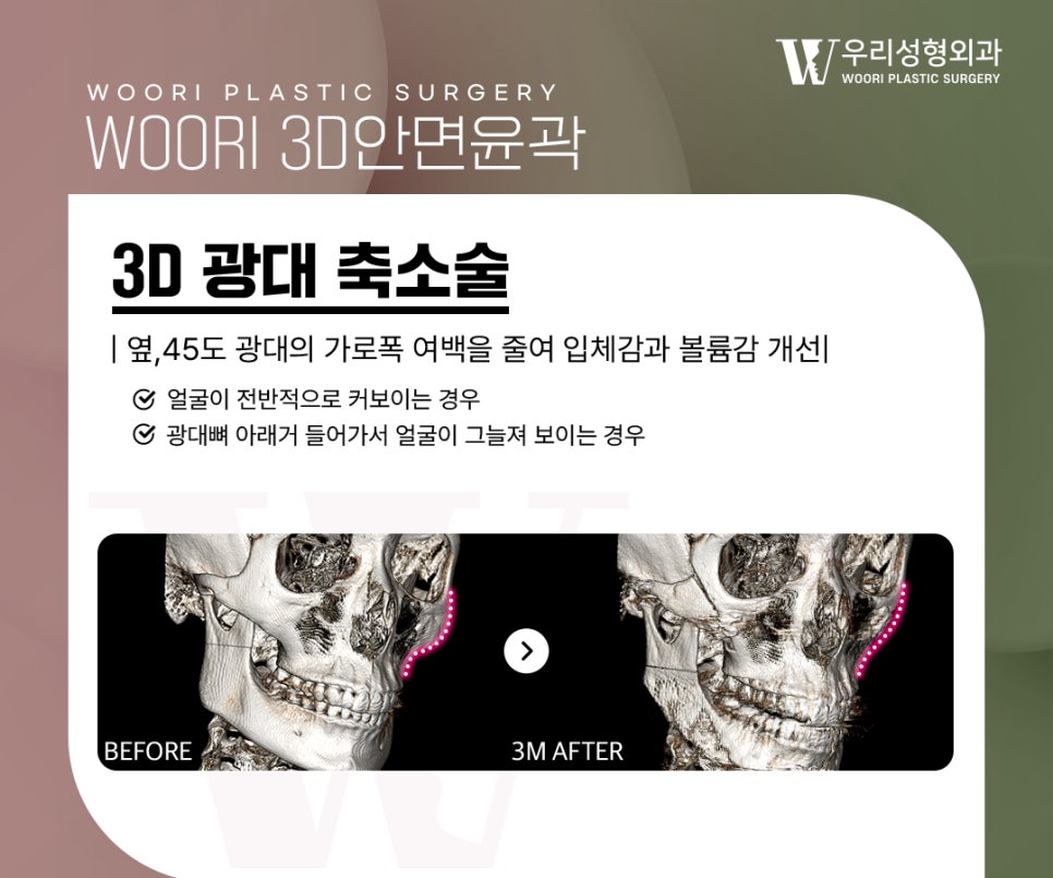 안면윤곽수술 3종을 함께 하는 이유는 무엇일까요? 관련 이미지 3