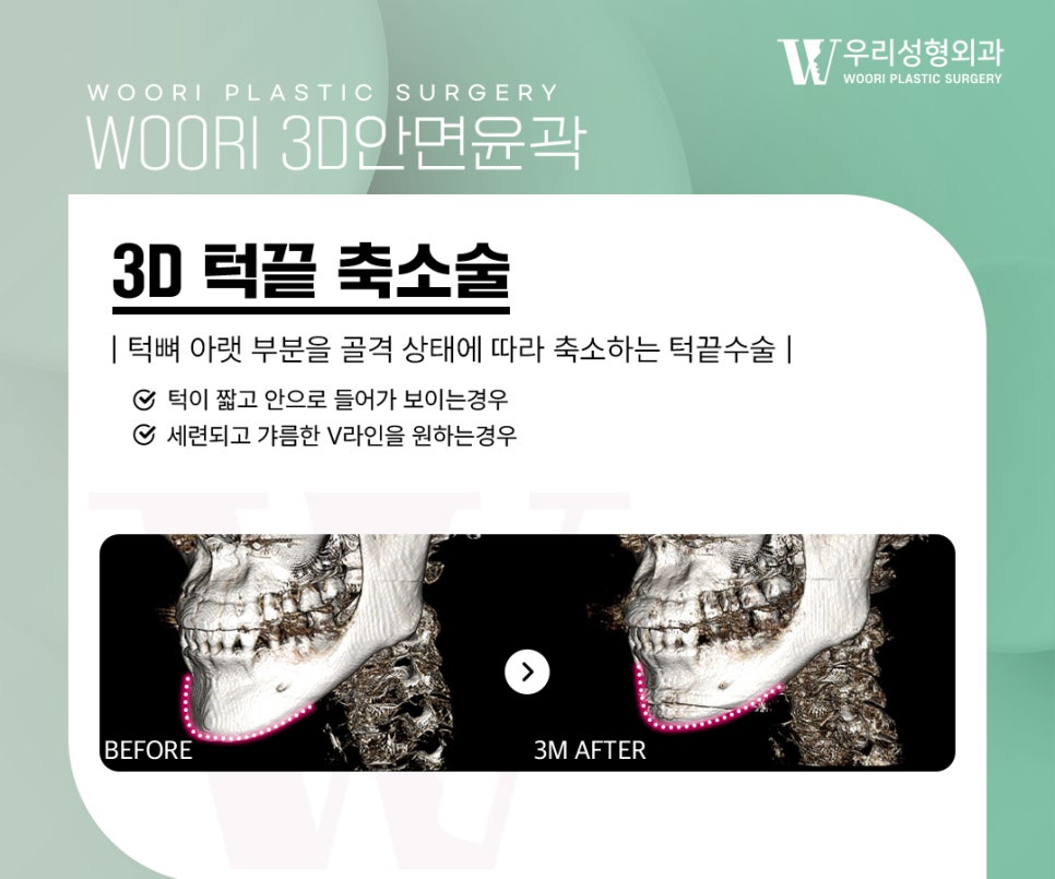 턱끝수술 후 부자연스러워 보이는 이유 관련 이미지 2