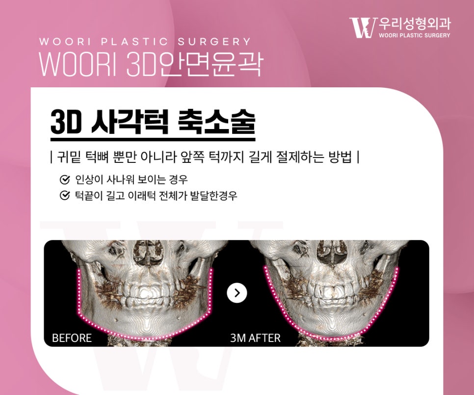 윤곽수술 광대, 사각턱, 턱끝을 모두 해야 할까요? 관련 이미지 2