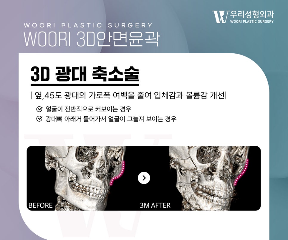 안면윤곽수술 3종을 모두 해야 얼굴형이 자연스러워질까요? 관련 이미지 3