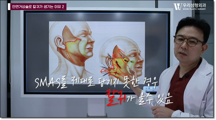 안면거상술 칼귀 걱정 된다면? 관련 이미지 4