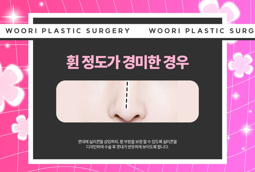 휜 코성형 방법과 코 수술 비용, 가격 궁금하다면 관련 이미지 6