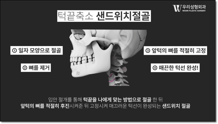 턱끝축소술 조화롭게 디자인 하려면 관련 이미지 2