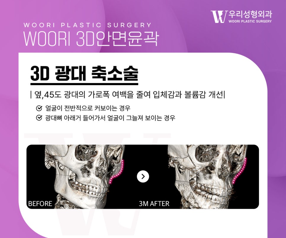 안면윤곽수술 자연스러운 얼굴선을 위해 중요한 것은? 관련 이미지 4