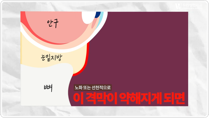 눈밑지방재배치 격막강화술이란 무엇일까 관련 이미지 2
