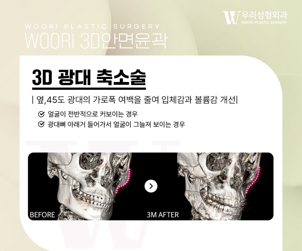 윤곽수술 얼굴형의 균형을 고려한 안면윤곽 방법 관련 이미지 3