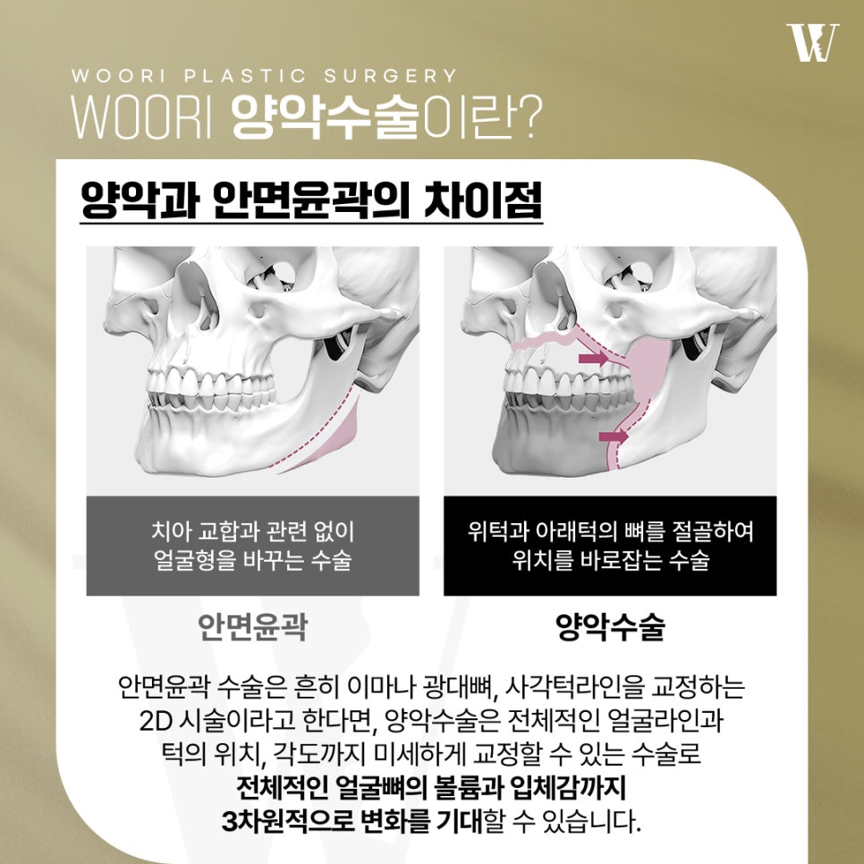 양악후기 주걱턱과 긴 얼굴은 수술 후 어떻게 달라질까요? 관련 이미지 3