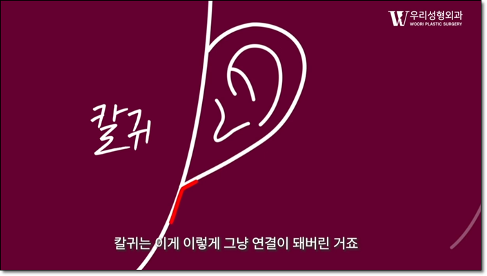 안면거상술 칼귀 걱정 된다면? 관련 이미지 2