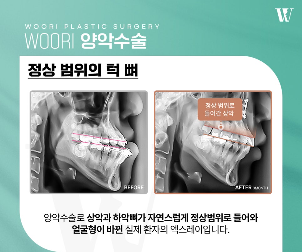 When Is It Difficult to Correct Facial Asymmetry with Contouring Surgery Alone? image 4