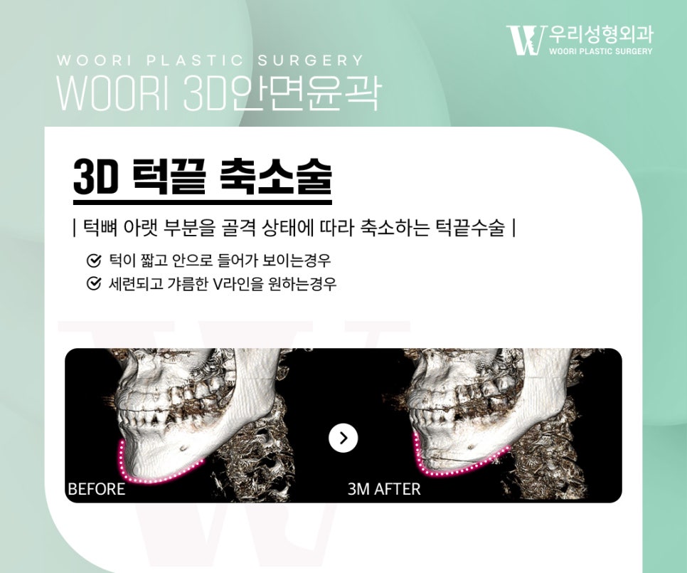옆광대축소 단독으로 해도 변화가 클까? 관련 이미지 4
