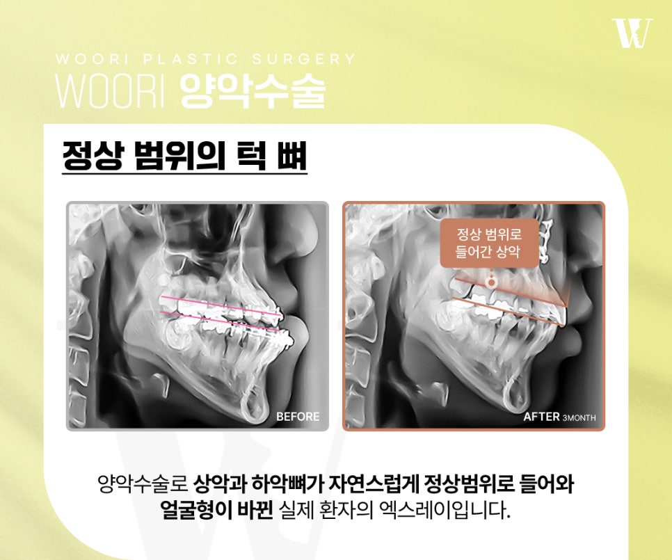 얼굴비대칭 양악수술로 개선 가능한 경우는? 관련 이미지 5