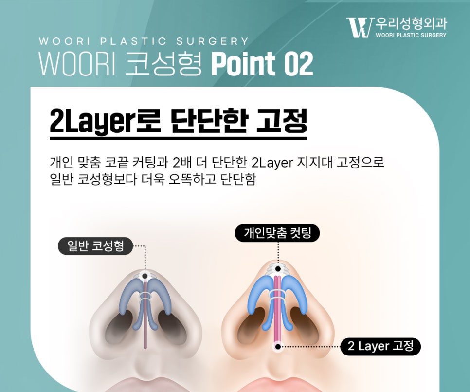 매부리코 수술 매부리만 없애는 것보다 중요한 것은? 관련 이미지 4