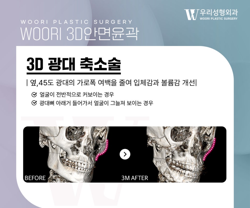 광대축소술 얼굴이 커 보이는 이유가 광대 때문일 수 있습니다 관련 이미지 2