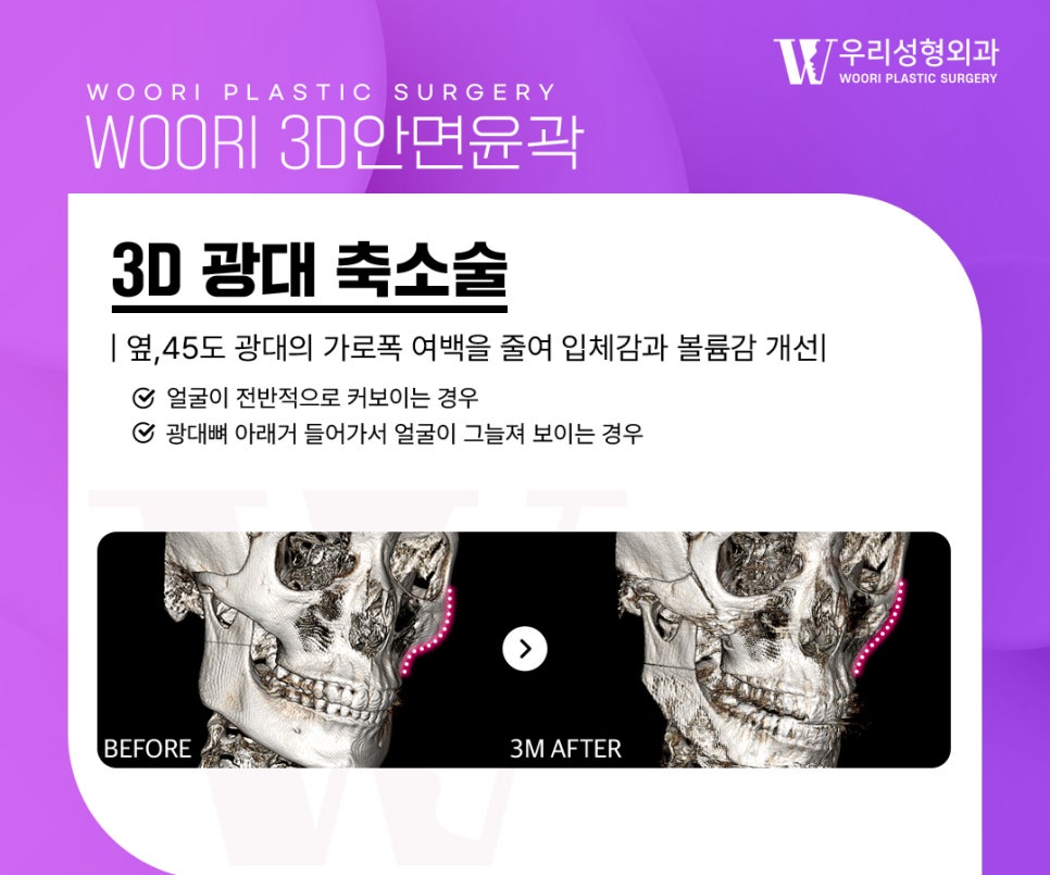 윤곽3종 한 가지 수술만으로는 부족한 이유 관련 이미지 3