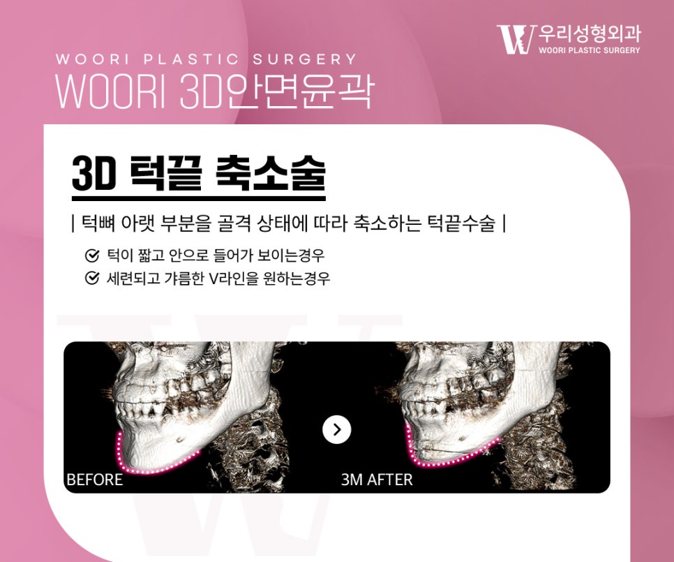 윤곽수술 광대, 사각턱, 턱끝을 모두 해야 할까요? 관련 이미지 4