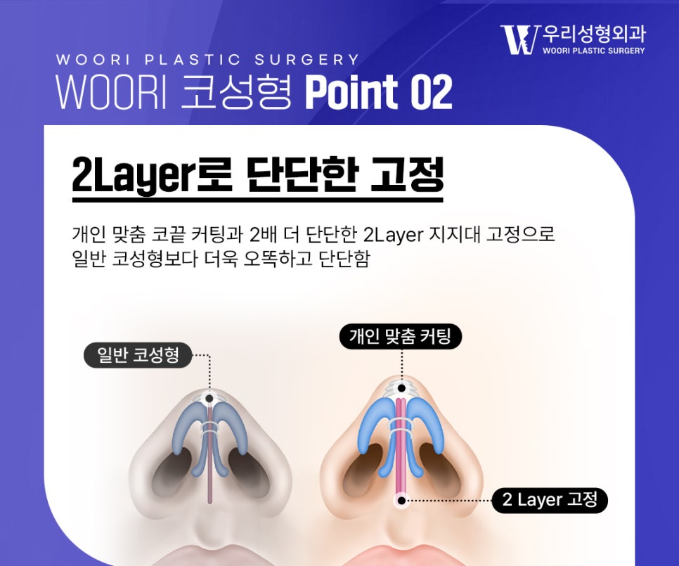 Accurate Analysis Matters More Than the Cause of Revision Rhinoplasty Failure image 3