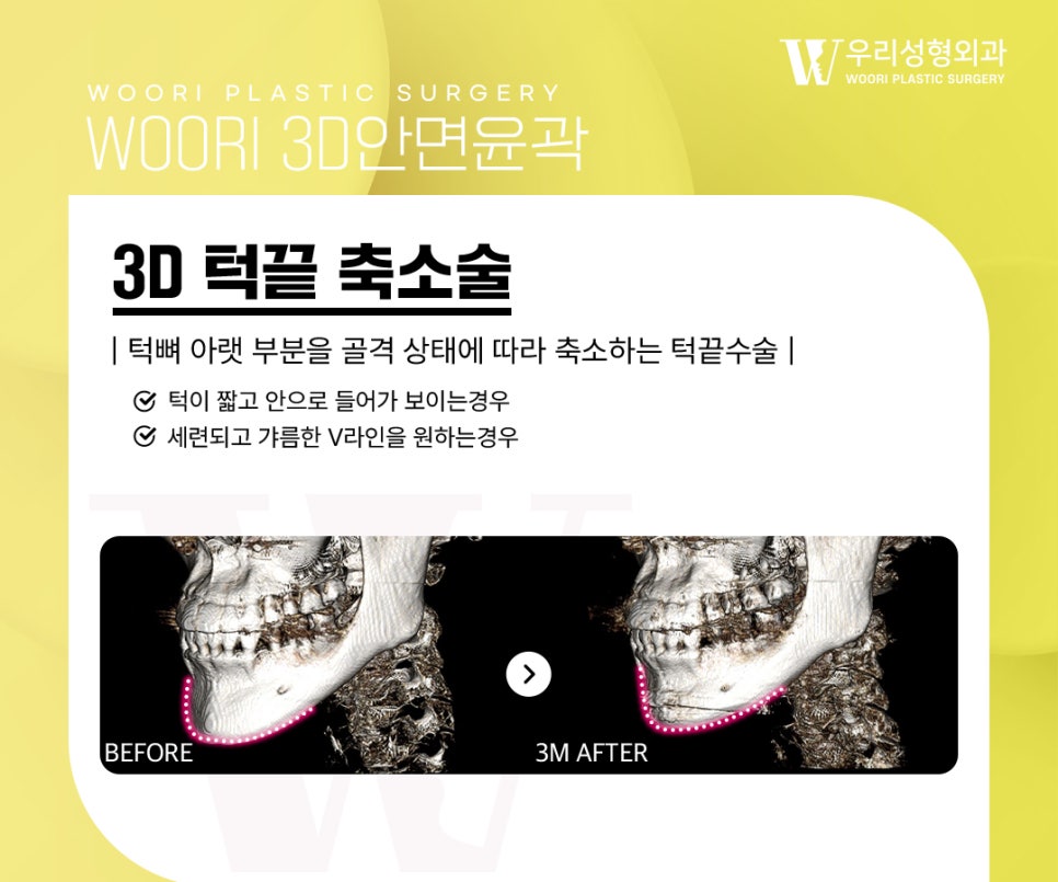 What to Check When Considering Square Jaw Surgery image 4