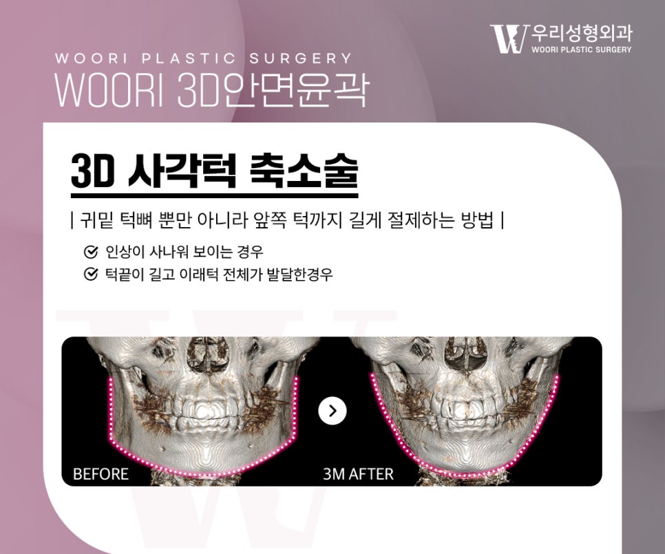 안면윤곽수술, 얼굴형을 정리하는 방법은? 관련 이미지 3