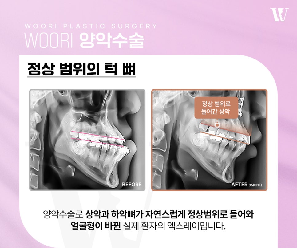 Why Facial Bone Balance Matters in Double-Jaw Surgery image 2