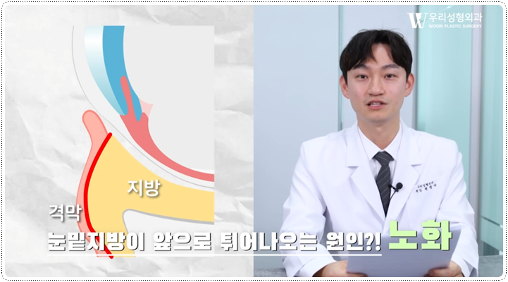 눈밑지방재배치 수술 유지기간 살펴보면 관련 이미지 2